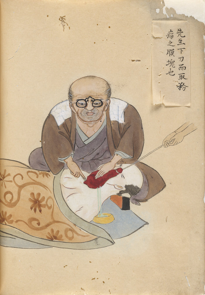 華岡青洲『竒疾外療図卷 完』